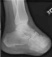 Lisfranc