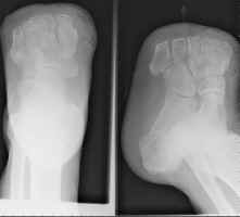 Lisfranc