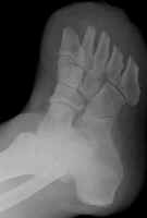 Transmetatarsal