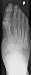 Charcot Joint: AP -