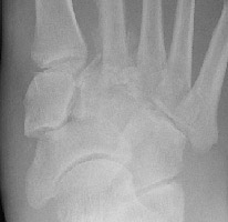 Charcot: AP - Dislocation tarsometatarsal joint