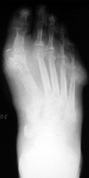 Tophaceus Gout: AP