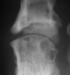 Silastic hemiarthroplasty with large erosions 1st metatarsal head.