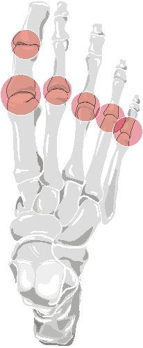 Ankylosing Spondylitis: Distribution