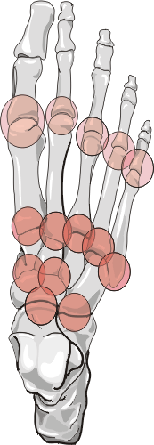 Neuropathic Joint Distribution