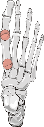 Osteoarthritis Distribution