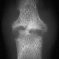 Psoriasis: Erosions 1st IP joint 