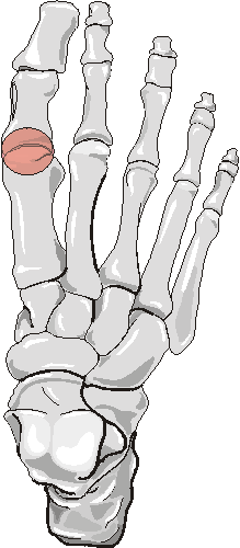 Silastic Arthropathy